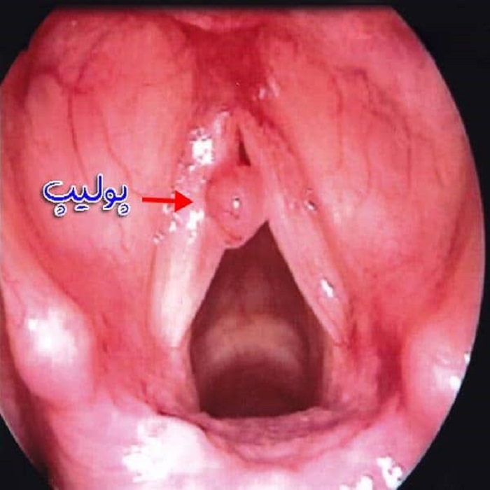 ضایعات حنجره